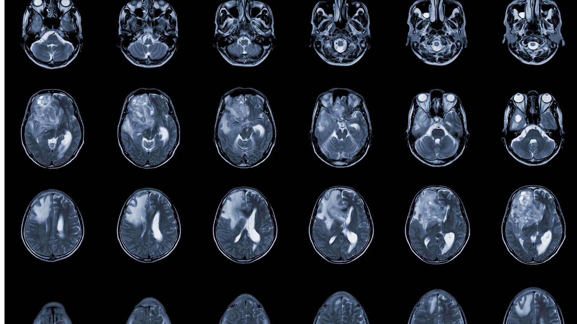 (TheraGlio-3D) Personalized 3D Tumor models for Precision ...